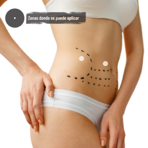 Lee más sobre el artículo Hilos tensores abdomen